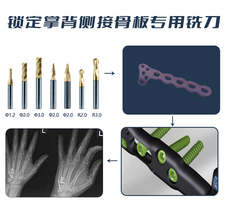 锁定掌背侧接骨板应用(3)