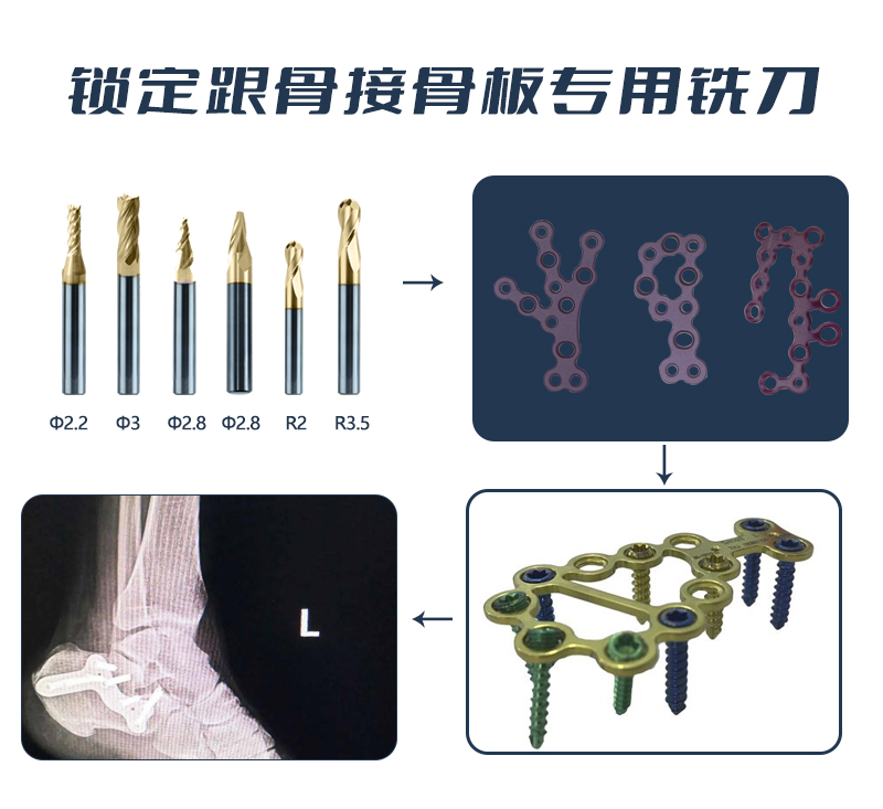 锁定跟骨接骨板应用 集合(1)1