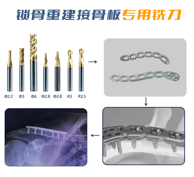锁骨重建接骨板(3)